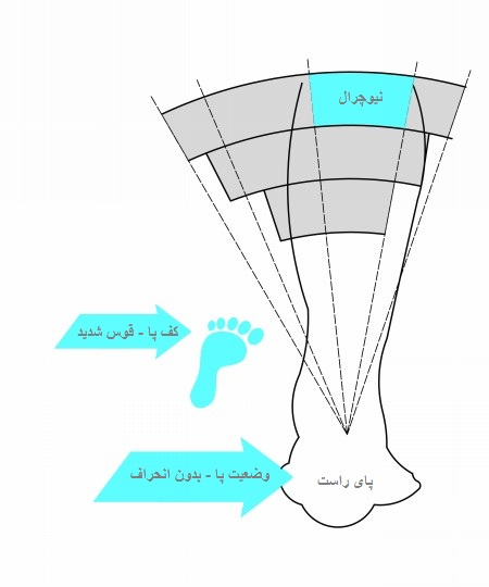 نیوچرال - قوس پای شدید